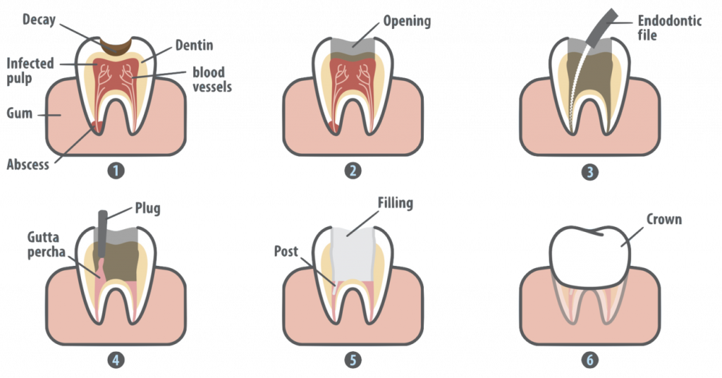 image-772360-Root-Canal-Treatment-.w640.png