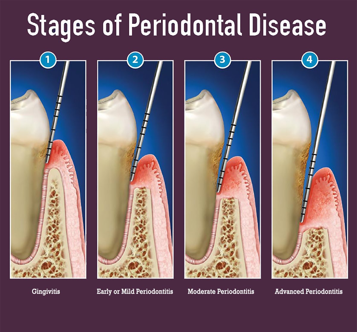 image-773501-graphic-2-stages-of-periodontitis.jpg