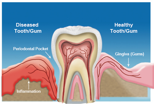 image-773502-gum-disease3.jpg