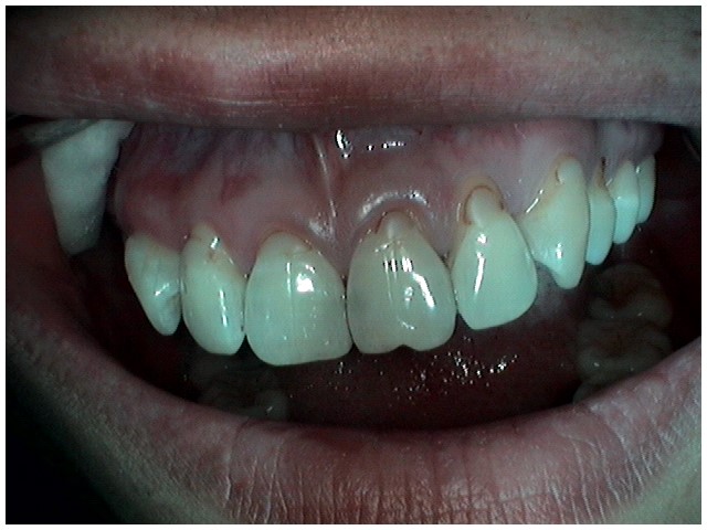 image-776260-vdentalfilling.jpg