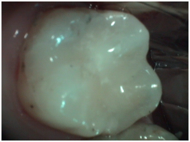 image-776262-vdentalfilling3.w640.png