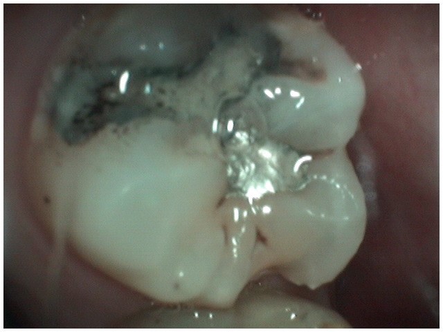 image-776263-vdentalfilling4.jpg
