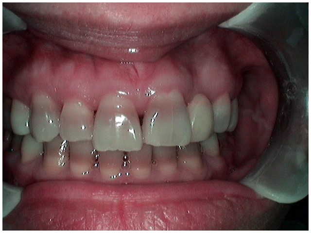 image-776285-Veneer5.jpg