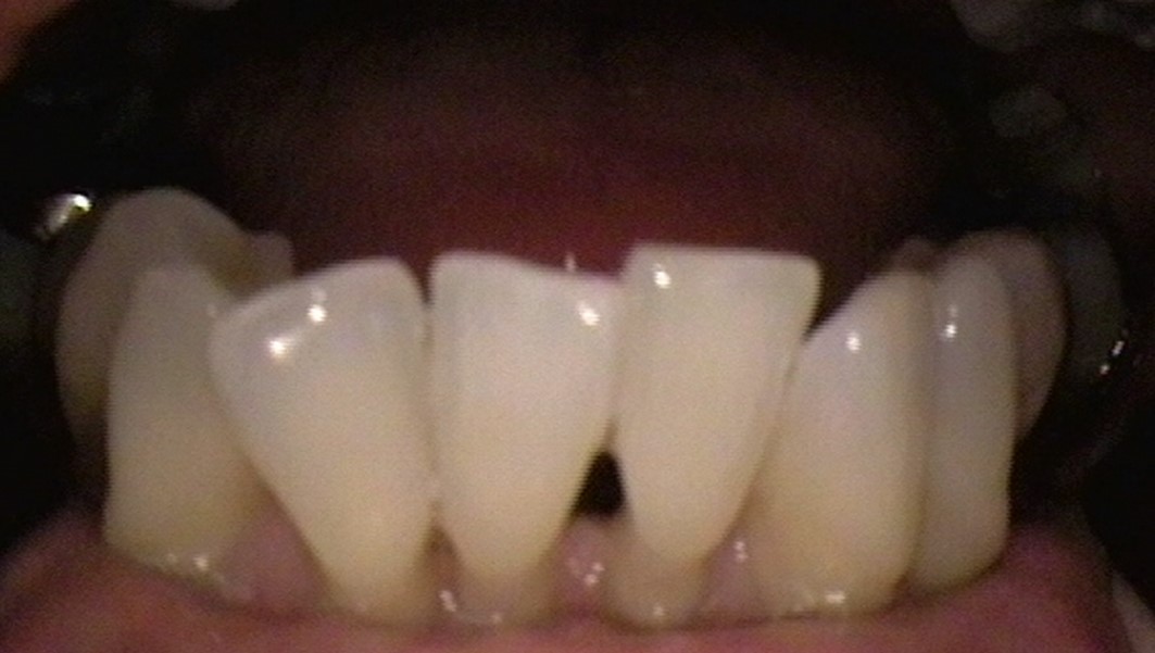 image-776291-Veneer11.jpg