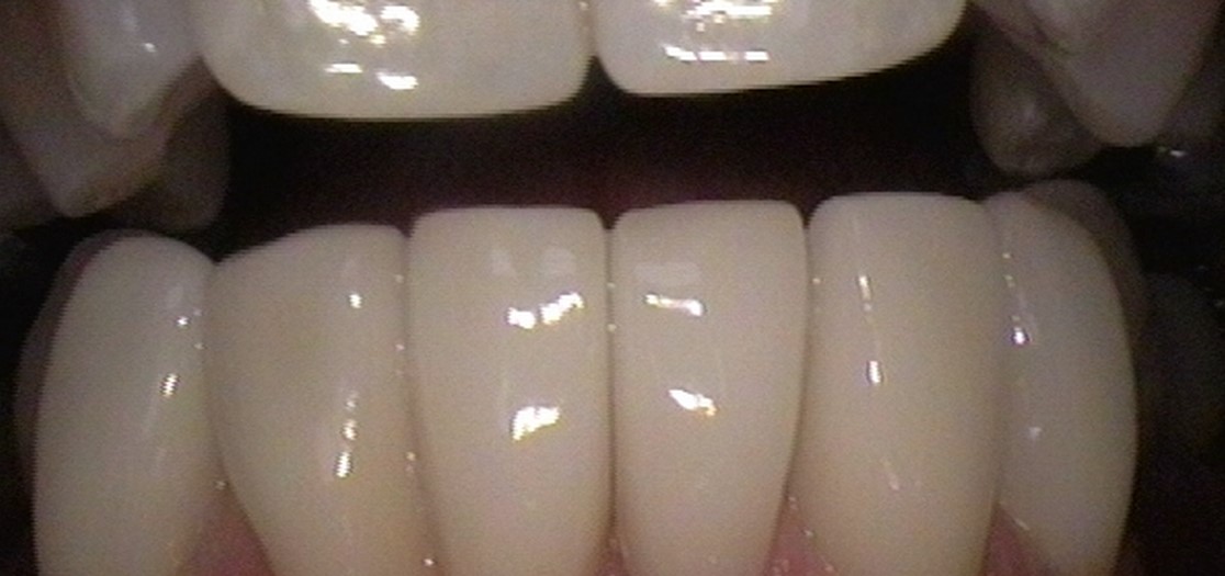 image-776292-Veneer12.jpg