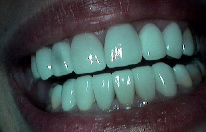 image-776296-Veneer16.jpg