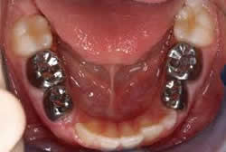 image-776449-stainless-steel-crowns-1.jpg